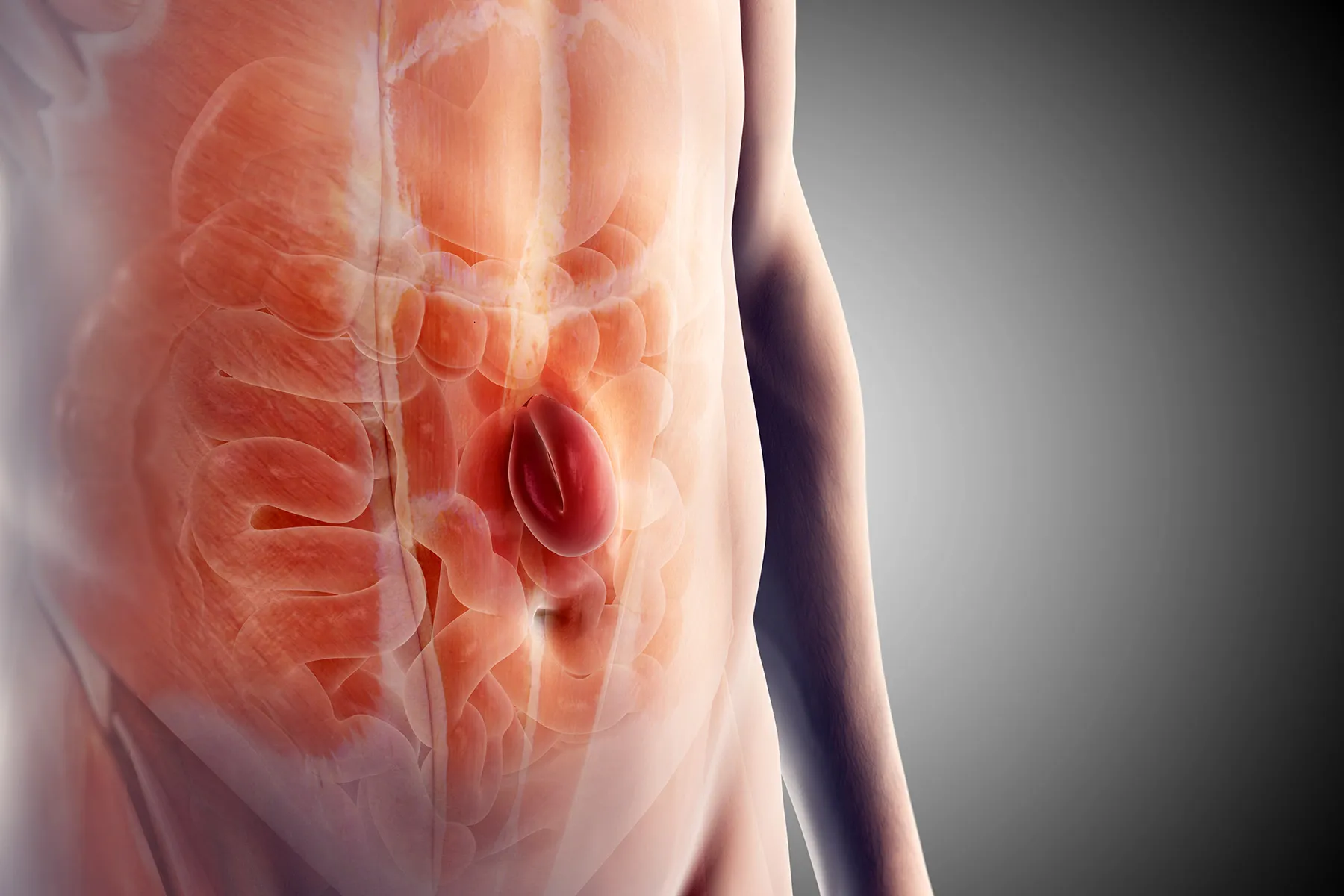 Hernia