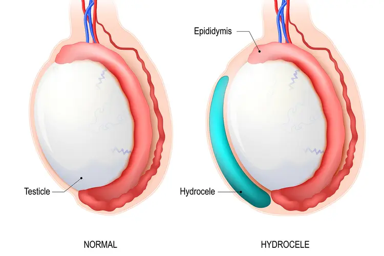 Hydrocele